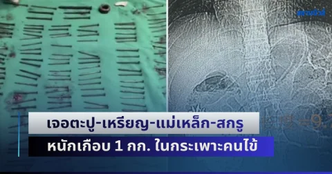 แพทย์อึ้ง! เจอตะปู-เหรียญ-แม่เหล็ก-สกรู กว่า 180 ชิ้น หนักเกือบ 1 กก. ในกระเพาะคนไข้ หลังมีอาการอาเจียนและปวดท้องรุนแรงนาน 9 วัน (ข่าวต่างประเทศ)