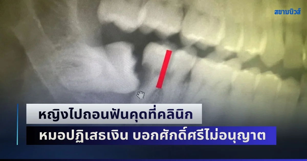 หญิงสุดงง! ไปถอนฟันคุดที่คลินิก ใช้เวลานานกว่า 3 ชม. สุดท้ายไม่ได้ถอน ซ้ำหมอปฏิเสธเงิน บอกศักดิ์ศรีไม่อนุญาต (ข่าว ตปท.)